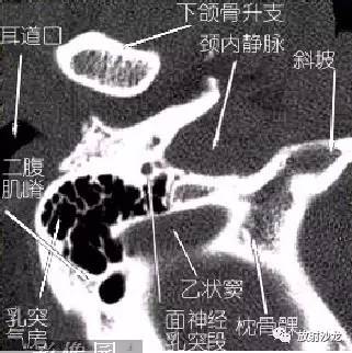 图 29 耳道口消失可见耳甲腔切迹.