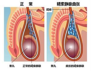 关于精索静脉曲张你必须知道的知识