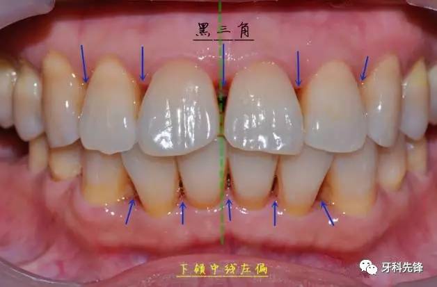 由于结石刺激牙龈退缩,前牙区黑三角很明显.