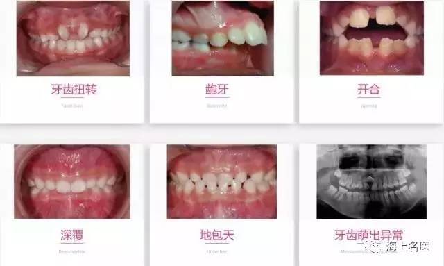 牙牙科普 | 孩子牙齿错位,牙列不齐? 儿童错颌畸形防治宜早不宜迟