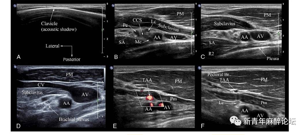 最新方法!超声引导下肋锁径路臂丛神经阻滞