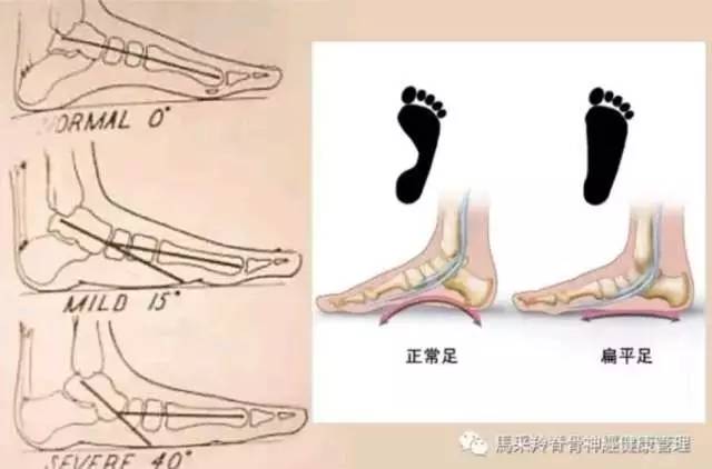 扁平足全方位指南