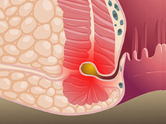 肛瘘人口_肛瘘手术图片