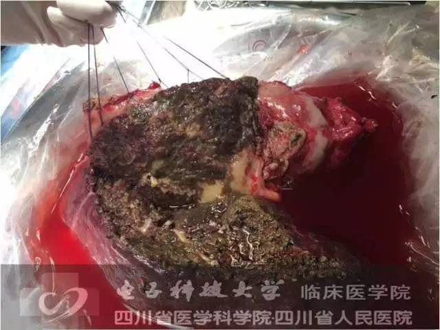 图文并茂:复杂肝包虫离体肝切除 自体肝移植术