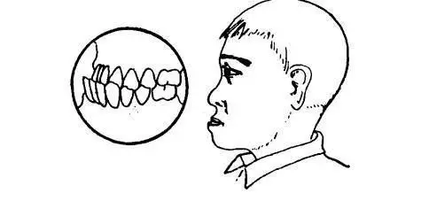 "地包天"作为一种口腔畸形疾病,对孩子的影响远没有那么简单