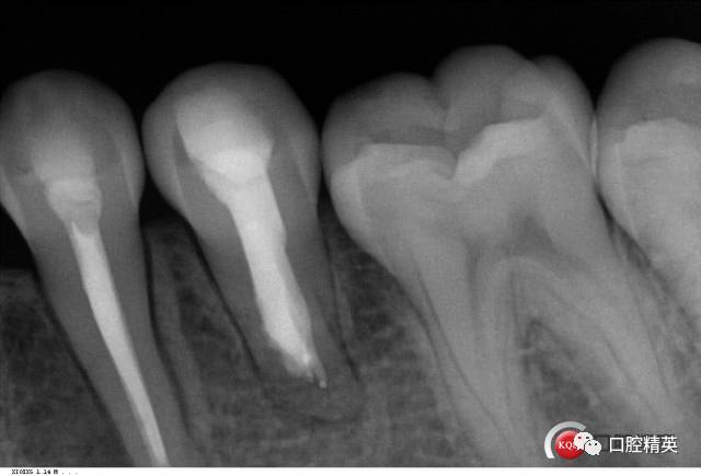 35根尖周炎根尖区破坏mta封闭一例