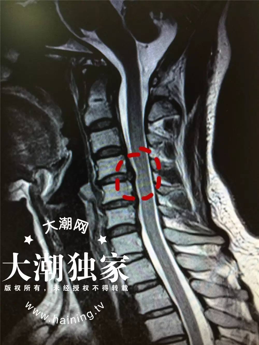 医生一检查发现, 汪小姐3-7节的颈椎间盘都向后方突出了