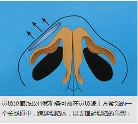 上海医生分享你不知道的自体软骨隆鼻