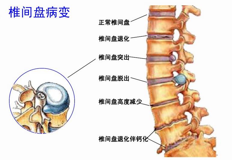 中医治疗腰椎病的原理是什么_幸福是什么图片