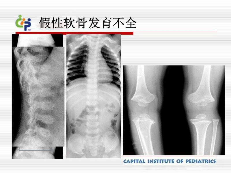 假性软骨发育不全