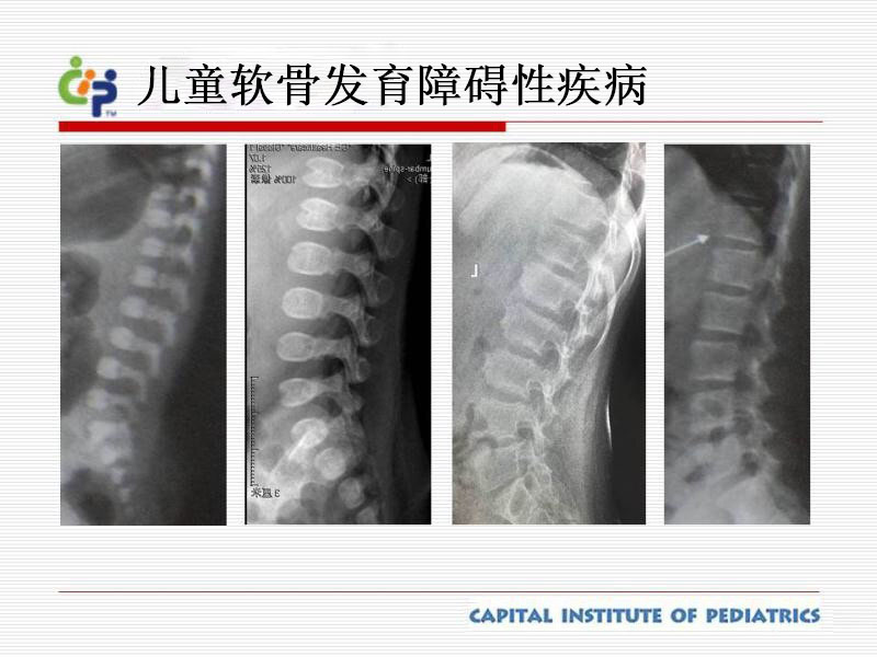 软骨发育不全,假性软骨发育不全,脊柱骨骺发育不良(先天型/晚发型)