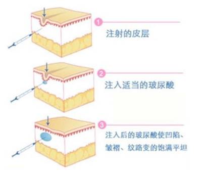 今日科普注射除皱用玻尿酸好还是肉毒素好