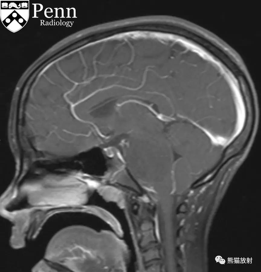 【双语病例】弥漫性内生性脑桥胶质瘤(dipg)-影像表现有特征!
