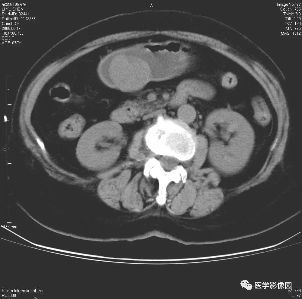 第六章腹部第六节胃肠道和腹膜腔病变四胃肠道间质瘤丨精品连载