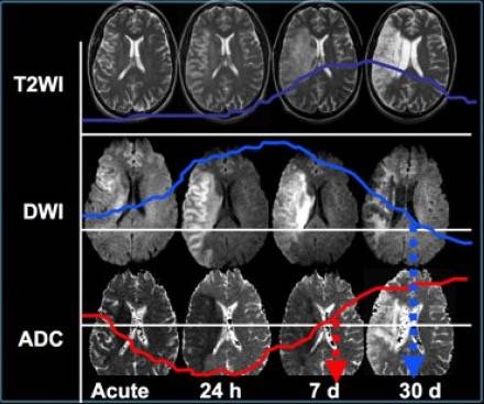 相关专业一文理清脑梗死dwi表现临床基础