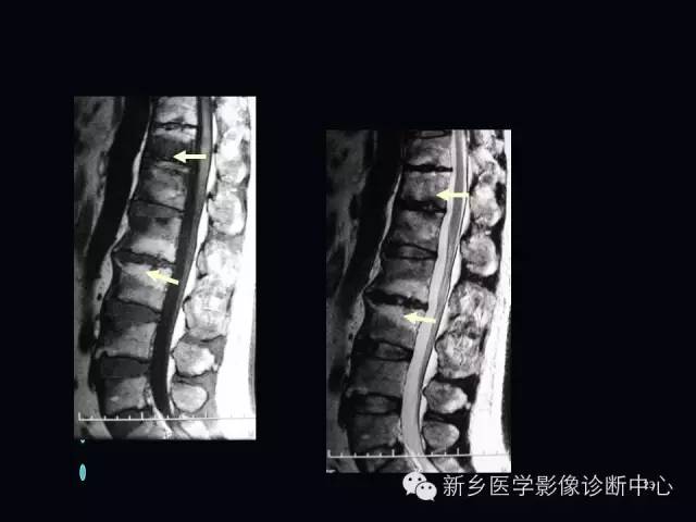 腰椎终板炎的mr分型