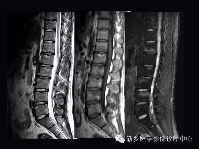 腰椎终板炎的mr分型