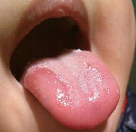 育儿:宝宝出现这5种舌苔情况 家长需要注意