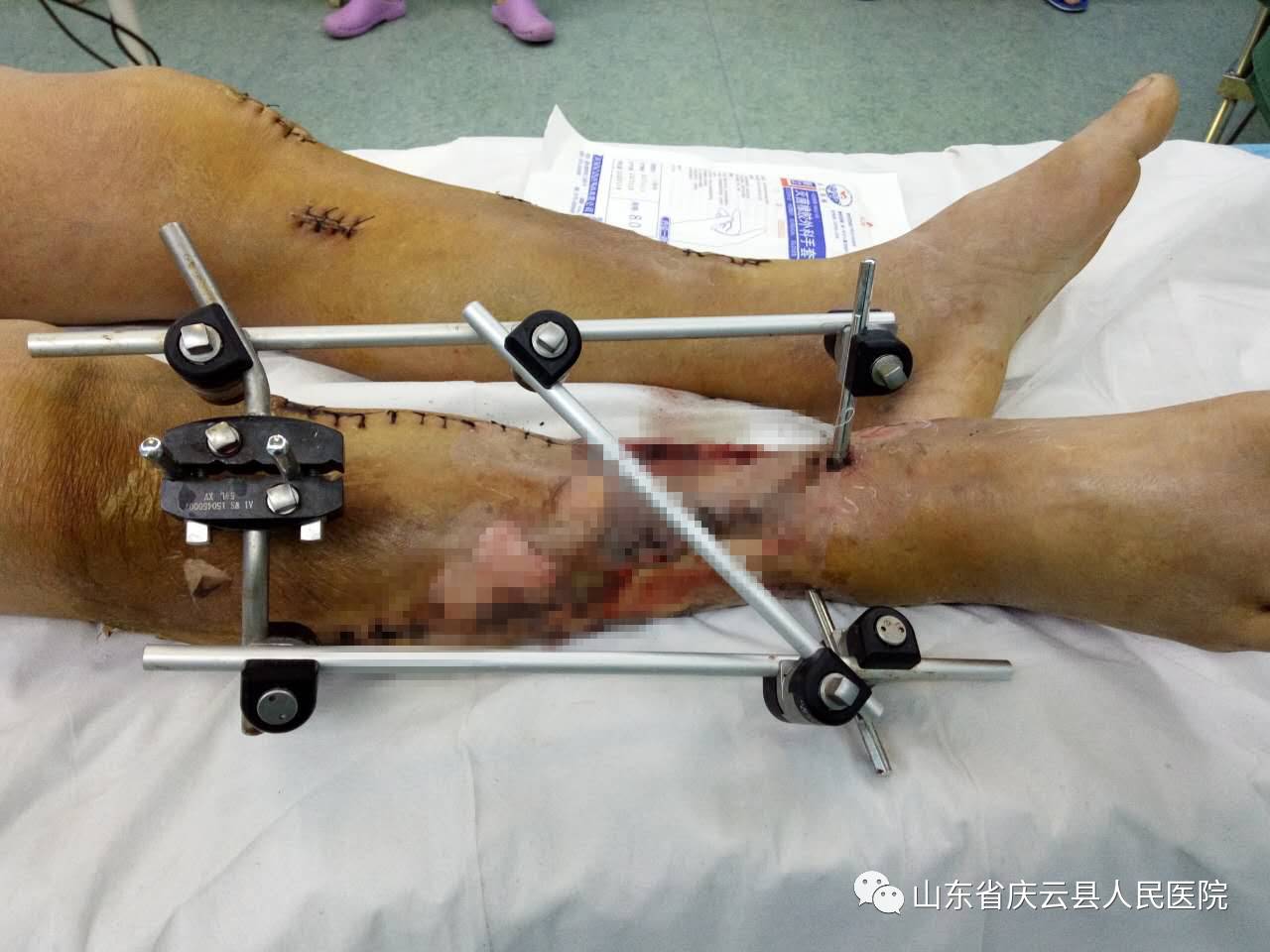 庆云县医院成功完成一例双下肢创伤性骨折修复治疗病例