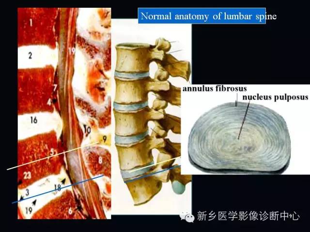 腰椎终板炎的mr分型