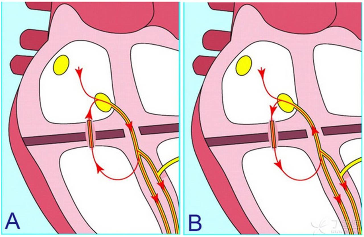 房室旁路径传导的本质是胚胎期心脏发育时,房室之间的纤维分隔不全