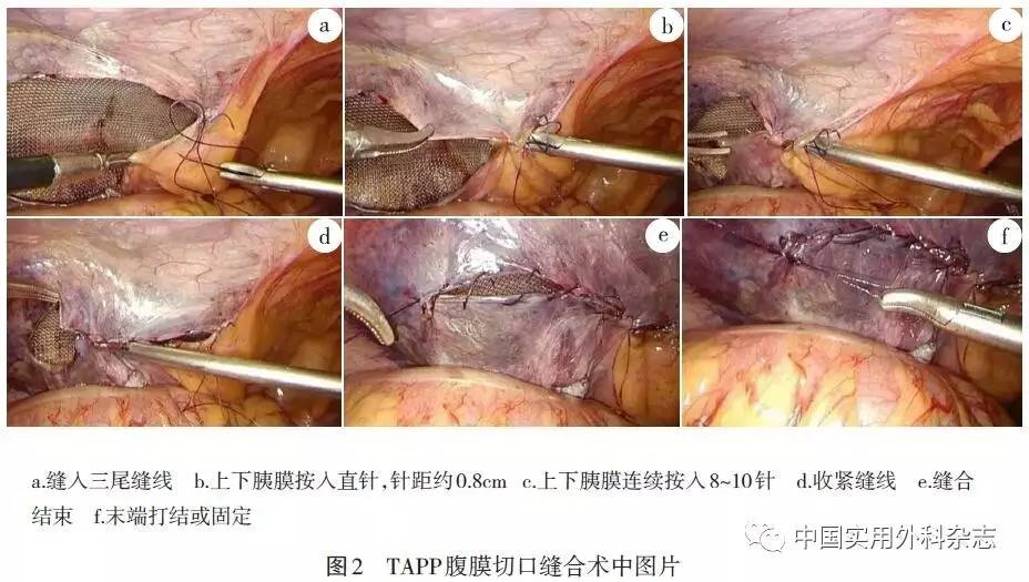 论著|自制直针三尾免打结缝线在tapp腹膜缝合的应用