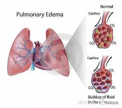 【x线诊断要点】肺水肿,肺栓塞和肺梗死(结合ct)上