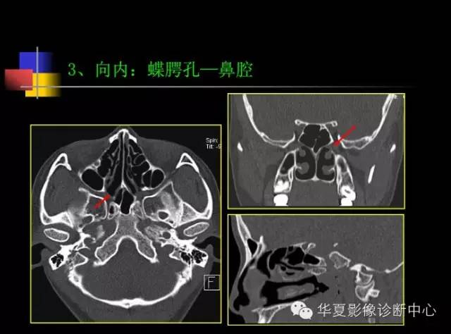 图文并茂 — 鼻咽ca报告必须知道的解剖结构