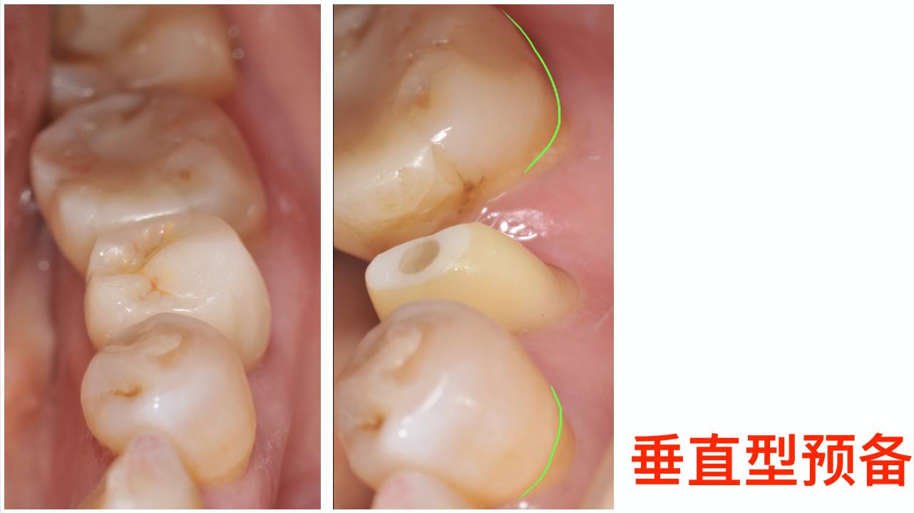 修复课】瓷贴面修复&垂直型牙体预备临床前沿技术研修班|深圳站-刘峰