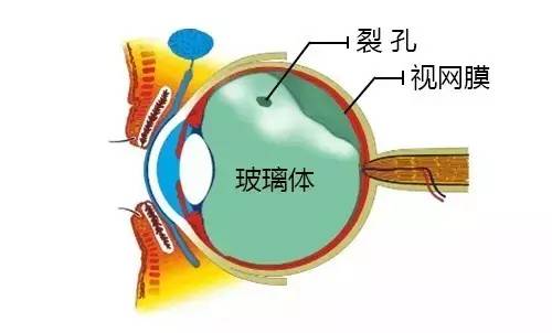 就是当眼内50%以上的玻璃体都出现了液化,整个玻璃体就像泄了气的皮球