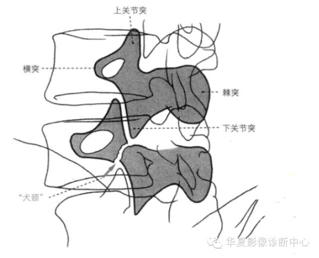 影像解剖基础腰椎椎弓峡部裂与椎体滑脱