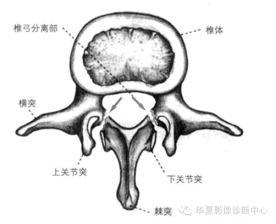 影像解剖基础腰椎椎弓峡部裂与椎体滑脱