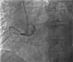 rca选择性造影(左前斜位)近段可见巨大负荷血栓图2.