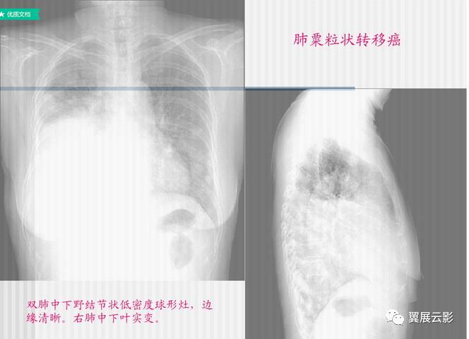 肺结核的影像学诊断