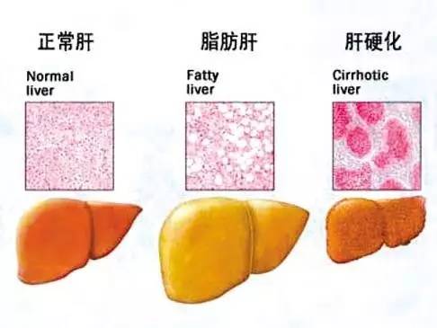 痛风,糖尿病,脂肪肝…为什么开始招惹年轻人?