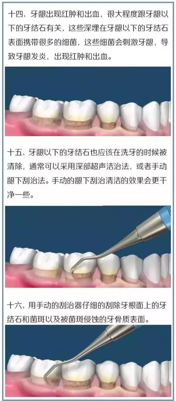 有了这张图洗牙过程一目了然