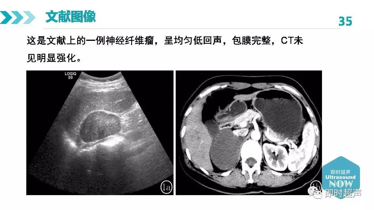 肾上腺正常解剖及疾病超声诊断