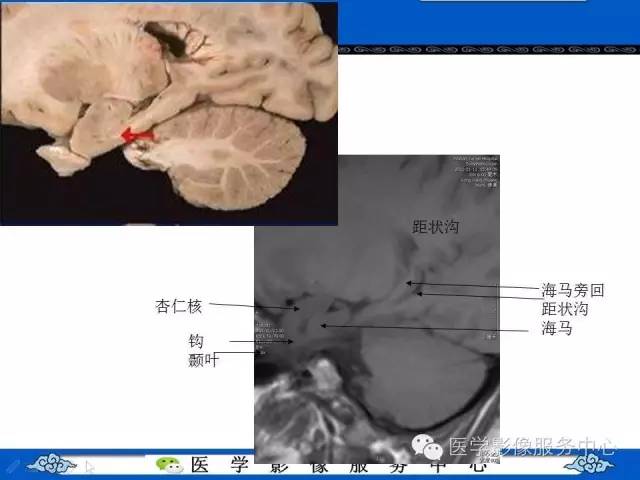 精彩幻灯 | 海马的解剖及萎缩分级