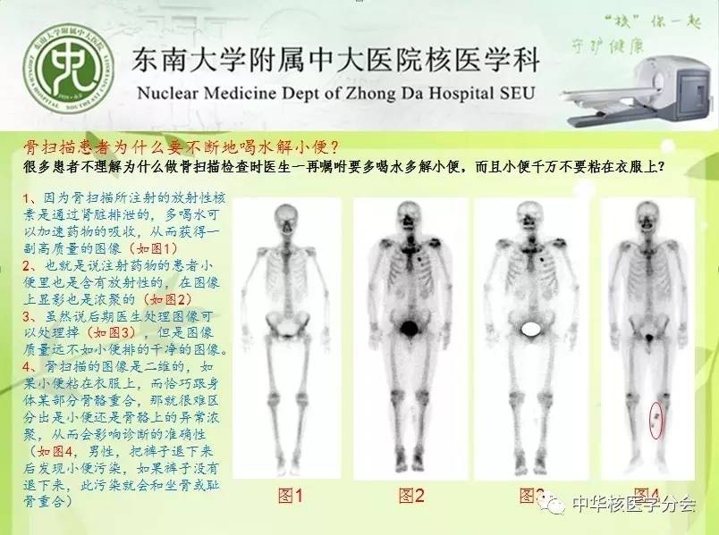 【揭秘】核医学骨扫描为啥要不断喝水上厕所?