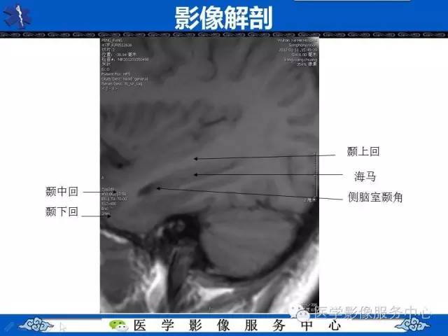 精彩幻灯 | 海马的解剖及萎缩分级