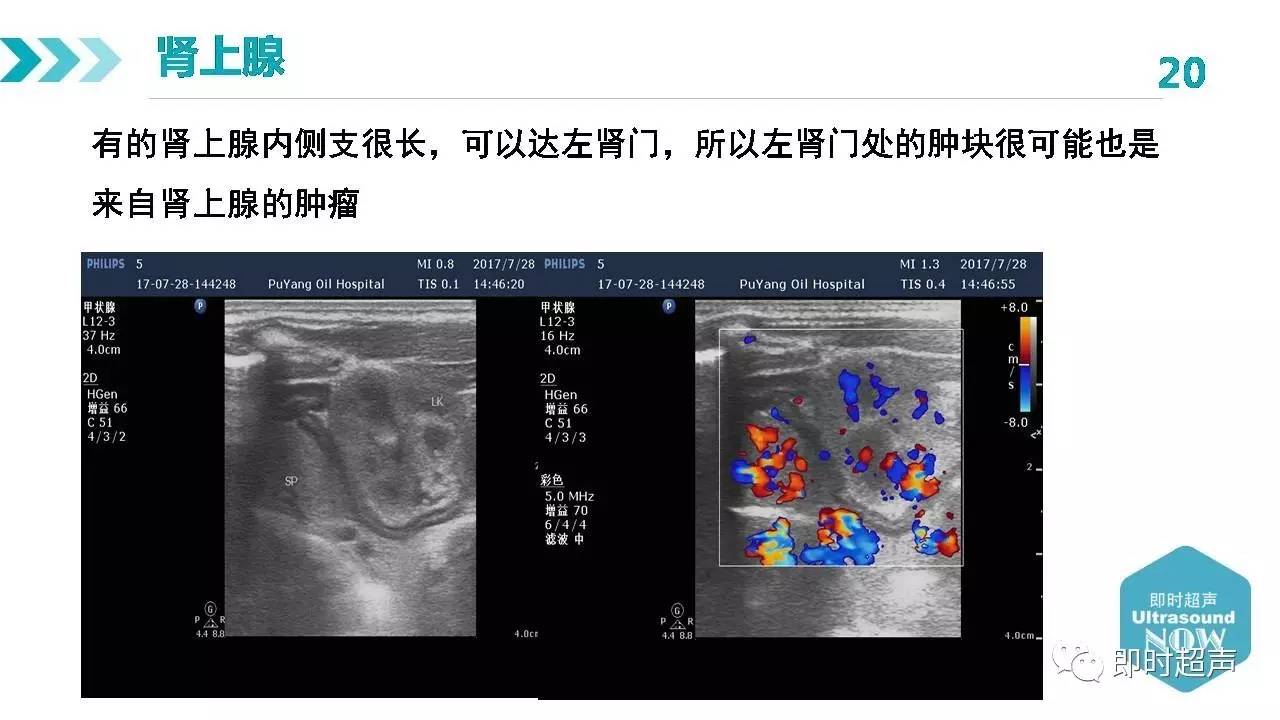 肾上腺正常解剖及疾病超声诊断