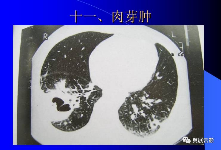 尘肺的影像表现及鉴别诊断