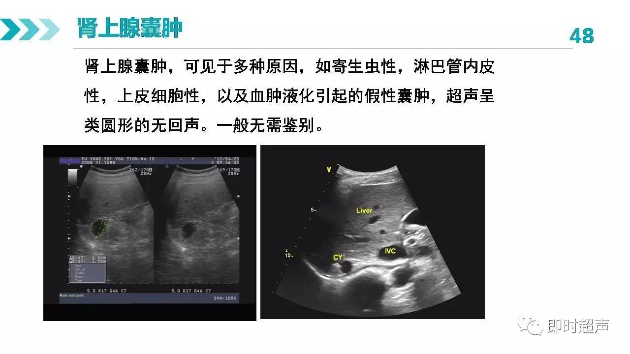 肾上腺正常解剖及疾病超声诊断