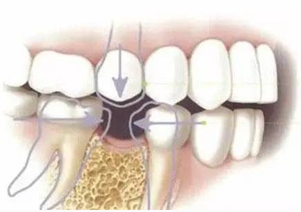 先天性恒牙缺失怎么办