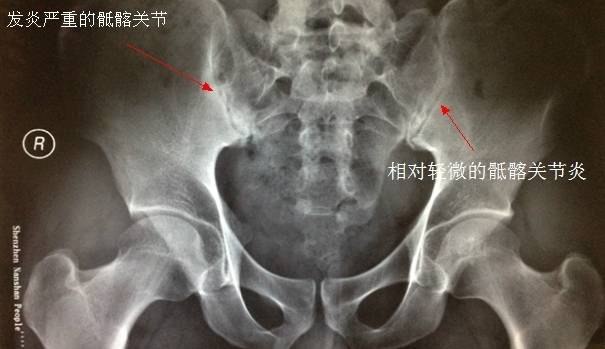 图:骶髂关节炎 x 线下表现呼吸系统表现最常见的呼吸系统表现多见为