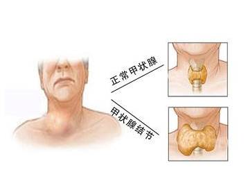 甲状腺在哪个部位图