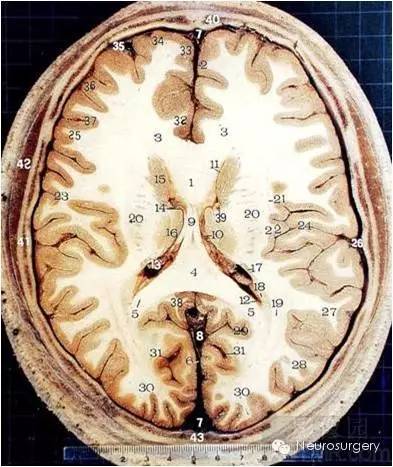 颅脑断层解剖图