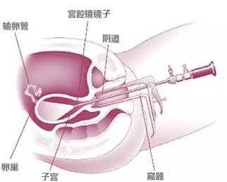 宫颈纳氏囊肿是慢性宫颈炎的一种表现,在育龄期女性中很常见,多由于