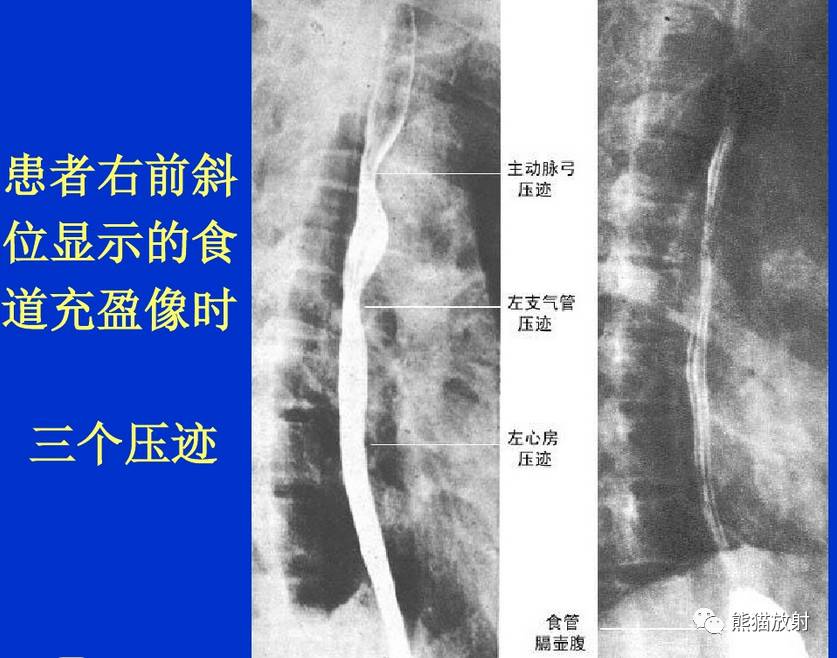 x线诊断要点胃肠道检查方法及正常x线表现24个相关问题