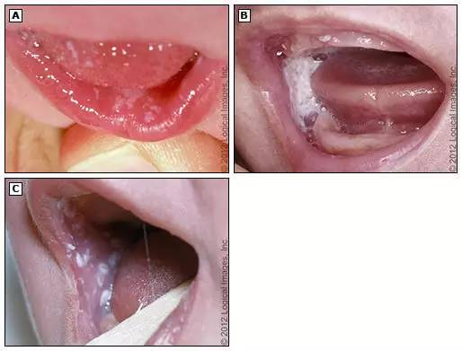 婴儿鹅口疮图片